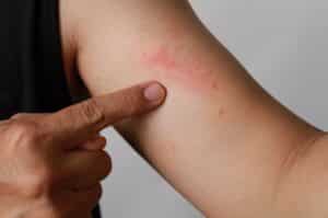 Les effets de la gemmothérapie contre l'eczema