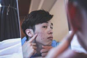 Un jeune homme qui a de l'acné devant un miroir